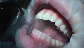 앞니 임플란트 시술과정