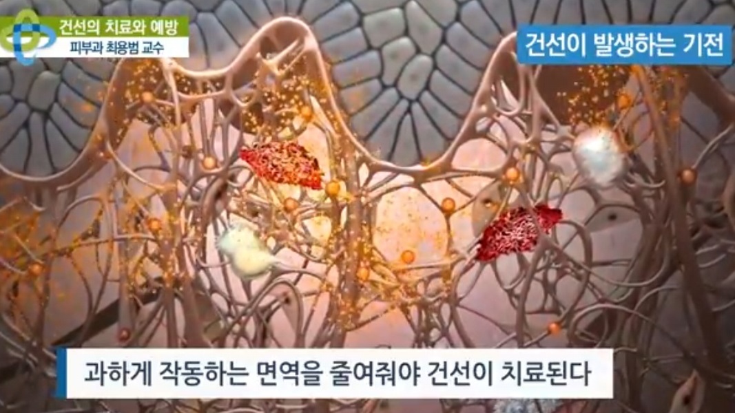 EBS명의-피부-명의-최용범-교수