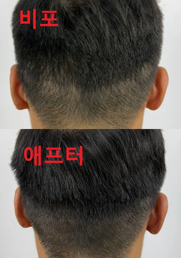 smp 두피문신 비포애프터