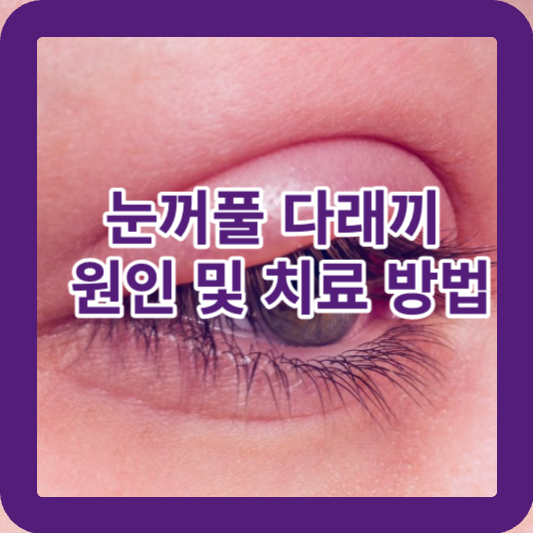 눈꺼풀 다래끼 원인 및 치료 방법