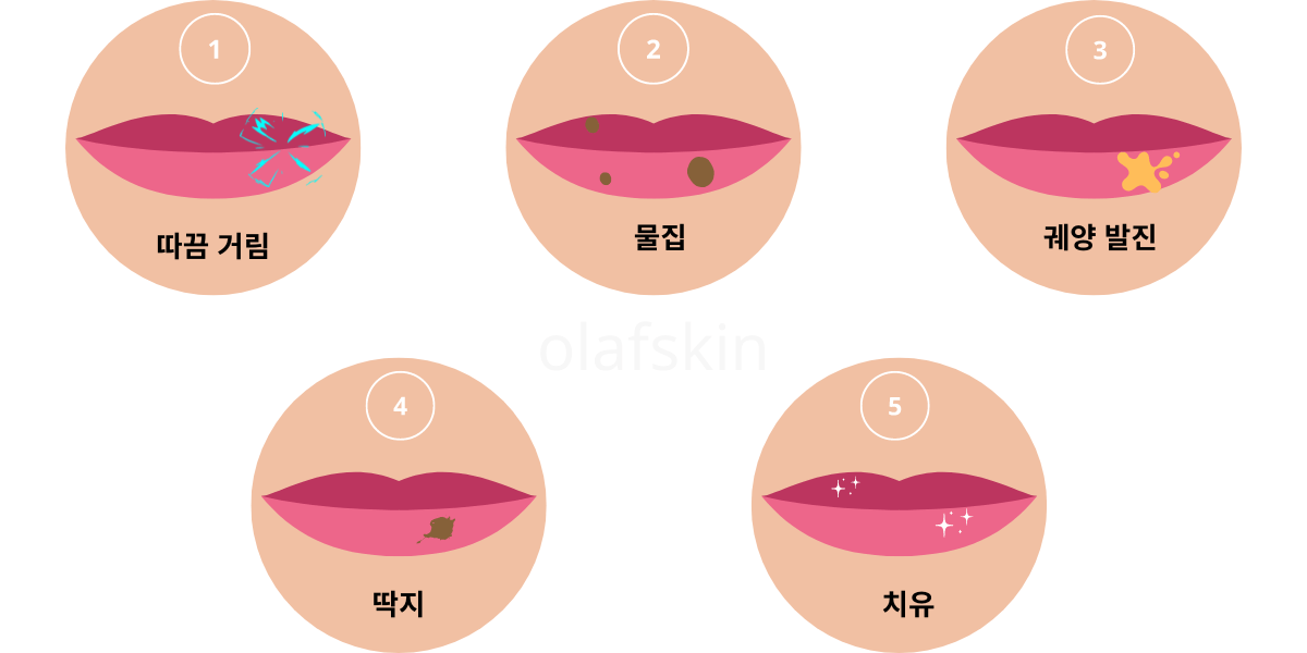 구순포진 원인 증상 – 갑자기 왜 나타났을까? 예방과 관리까지 정리끝!