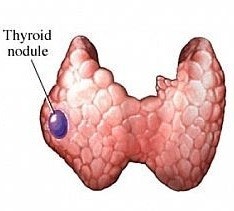 ebs 명의 갑상선 치료 예방