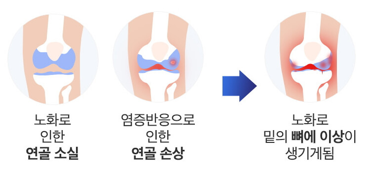 콘드로이친