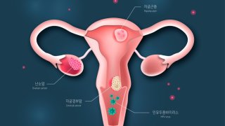 난소암 초기증상