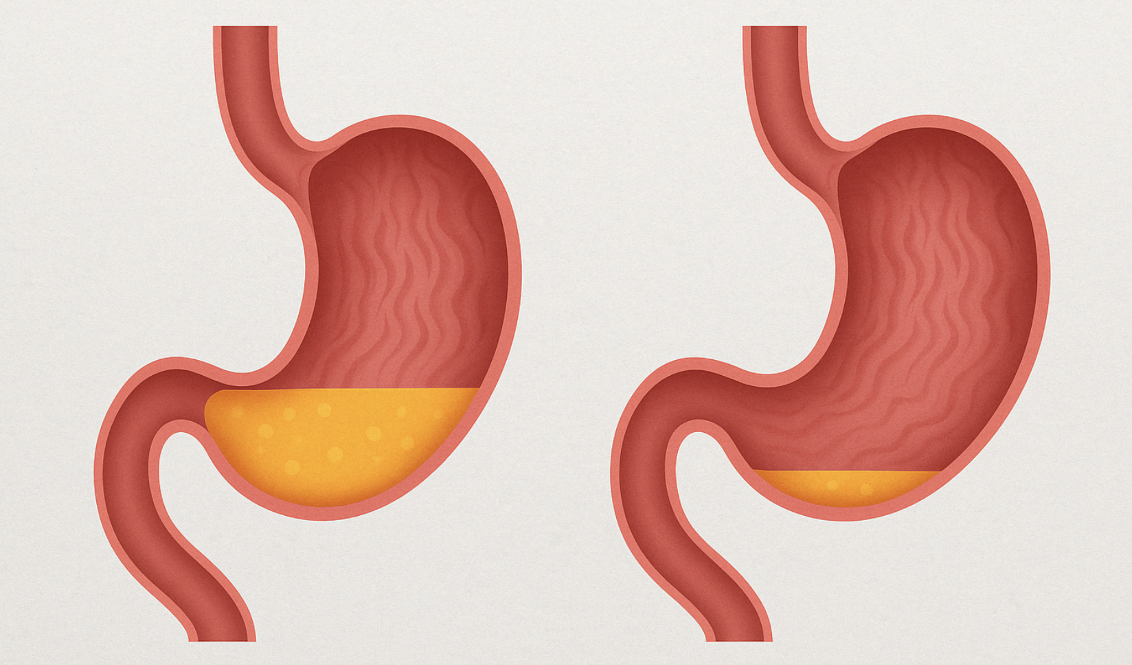 위산과다와 위산저하 상태를 도식화한 그림