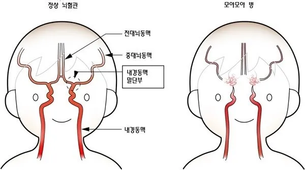 모야모야병 증상 및 원인과 장애등급 여부 알아보기