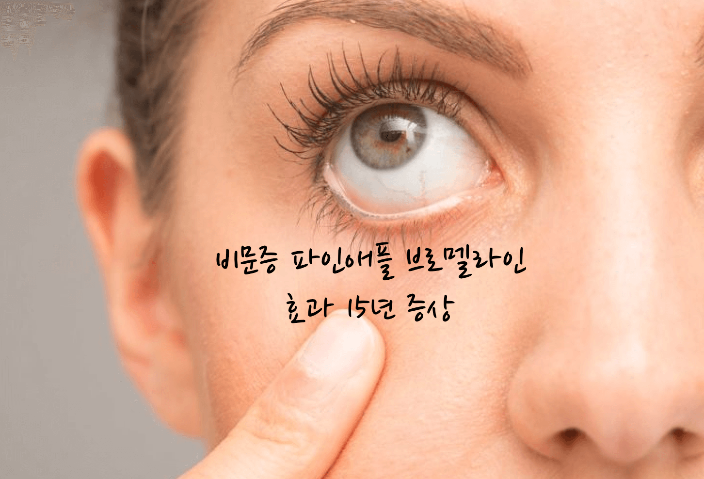 비문증 파인애플
