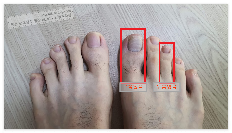 무좀이 줄어든 발