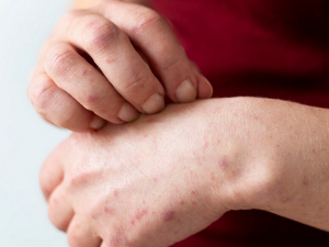 몸에 빨간 점이 생기는 이유