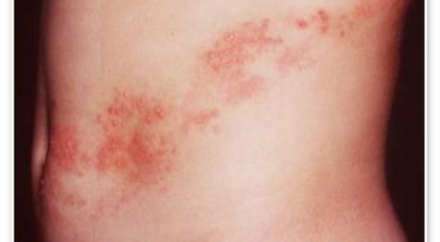 대상포진이미지