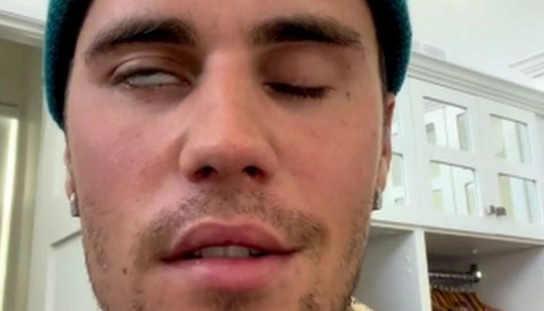 안면마비 발병 원인