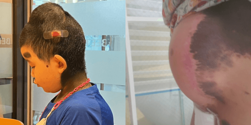 수술받은 다은이