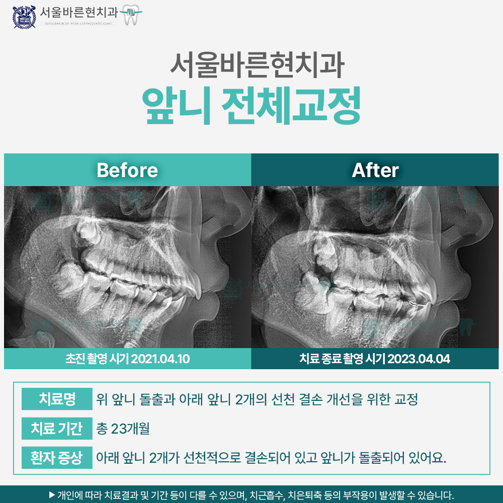 부산앞니교정