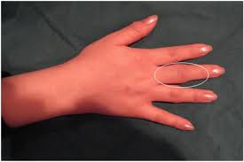 손가락 마디 통증