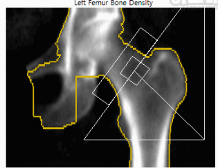 골다공증 수치보는법