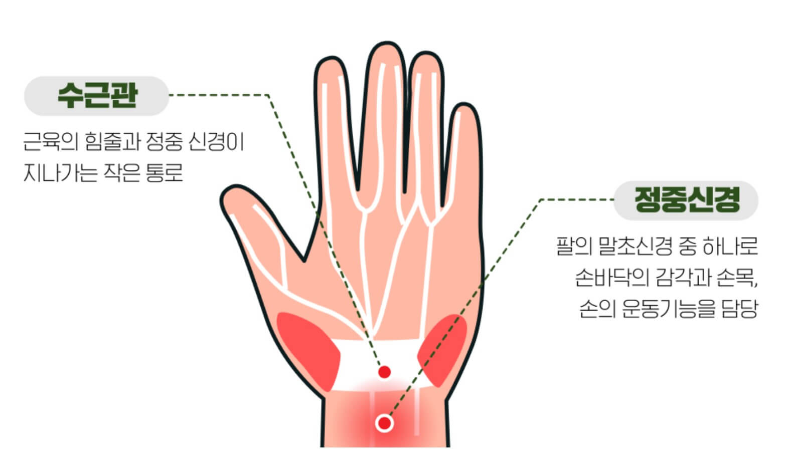 손목터널증후군-위치2