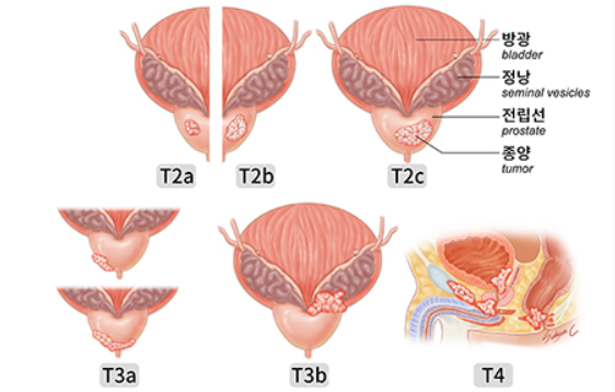 전립선암의 T병기 그림