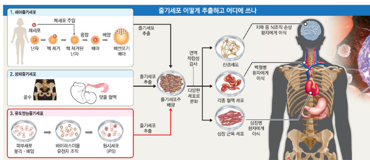 줄기세포치료