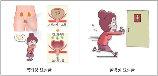 요실금 증상 요실금 치료지원 요실금 팬티