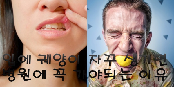 구강암