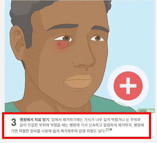 손가락 가시 빼는법 소개