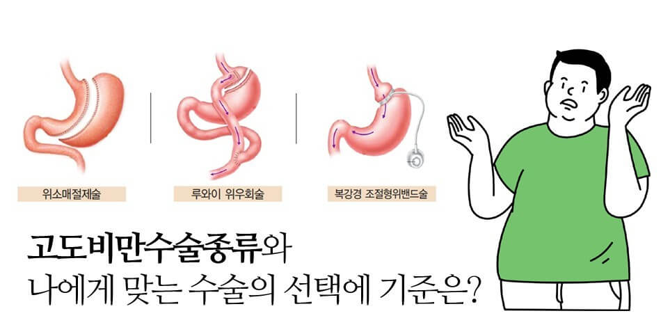비만치료-수술