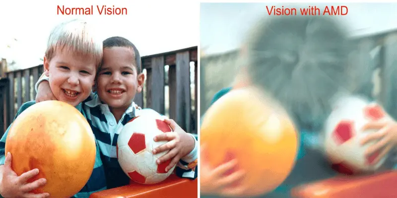 노령 관련 황반변성(Age-related Macular Degeneration&#44; AMD)