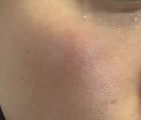 실제 본인 피부사진, 민감성 피부 홍조 원인 혈관 확장 장벽 약화 사례 사진