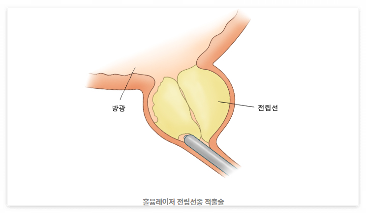 전립선 비대증 치료
