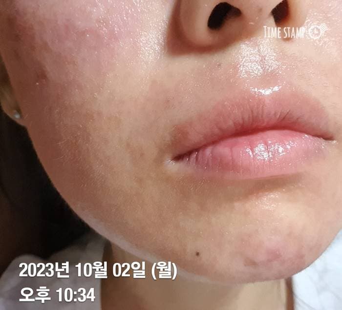 입술 피부염