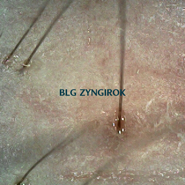 피나모아 복용 20주차 - 오른쪽 M자 부위 두피 모습이다.