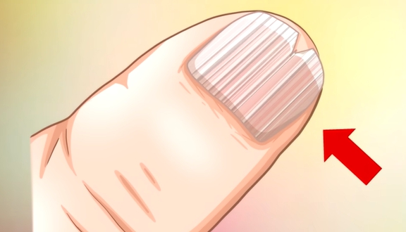 손톱에 세로줄이 생기는 이유