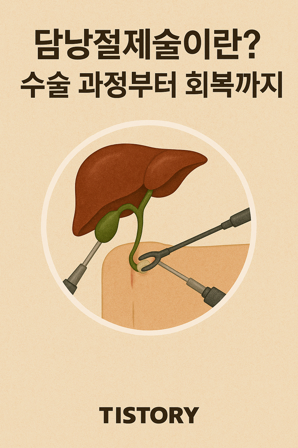 담낭절제술이란? 수술 과정부터 회복까지