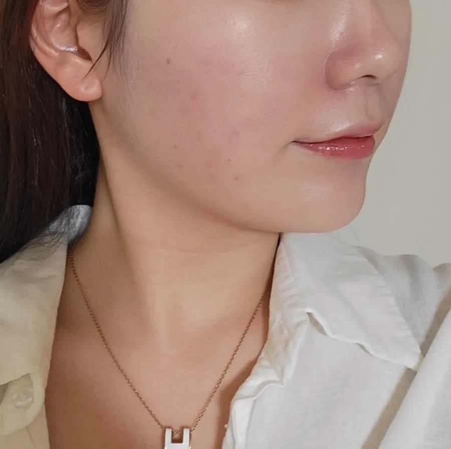 bbl 레이저 후기