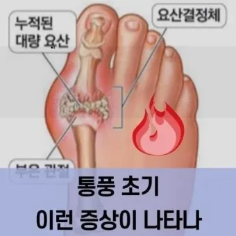 발가락 통풍 증상 및 대처방법_24