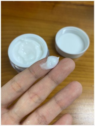 지루성 피부염 증상