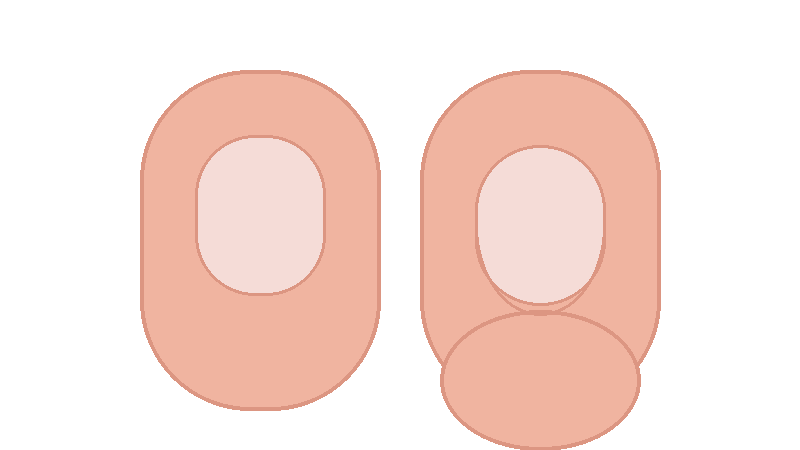 곤봉지(Clubbing)란? 손톱이 둥글게 휘고 손끝이 뭉툭해질 때 확인해야 할 것들