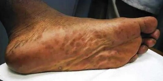 매독 2기, 발진 증상