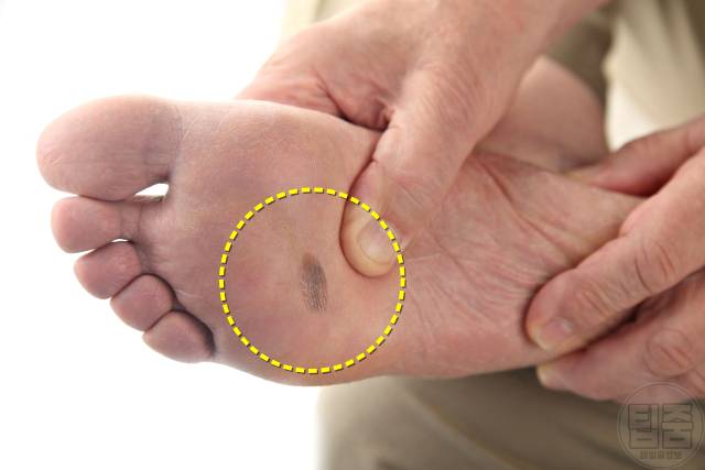 피부암 호발 부위 피부암자가진단 발바닥