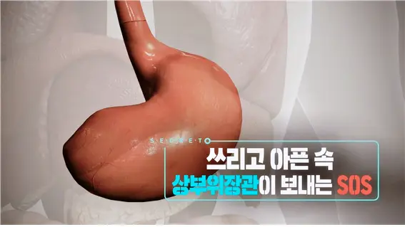 KBS 생로병사의 비밀 822회 소화불량 속쓰림 가슴쓰림 쓰리고 아픈 속 위장질환 상부위장관 SOS