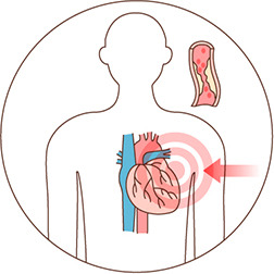 심근경색 초기증상