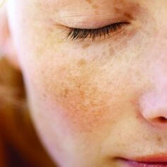 눈-주변과-광대뼈-부분에-기미가-많이-생긴-여성