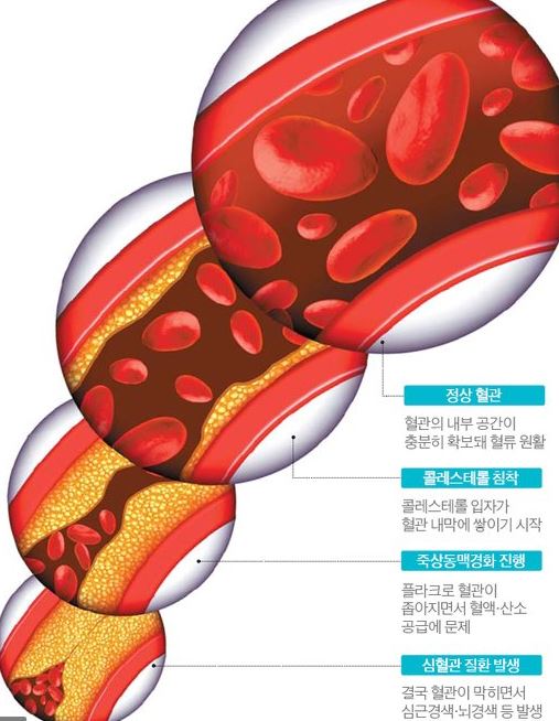 김광현신장경색