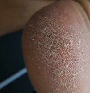 발뒤꿈치-갈라짐-통증