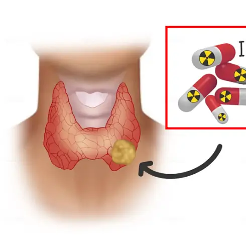 갑상선암 수술 후 방사성요오드 치료란?