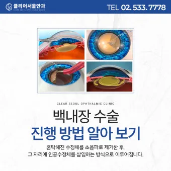 백내장 수술 비용 실비 보험 청구 회복기간_23