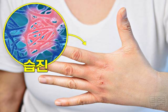 습진에 좋은음식 안좋은음식