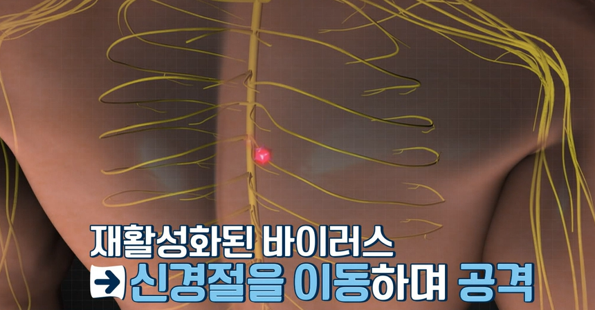 대상포진