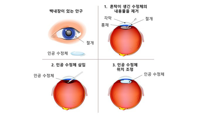 백내장 증상부터 원인, 치료까지! 시야가 흐려질 때