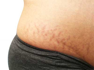 빨간 튼살 없애는 법